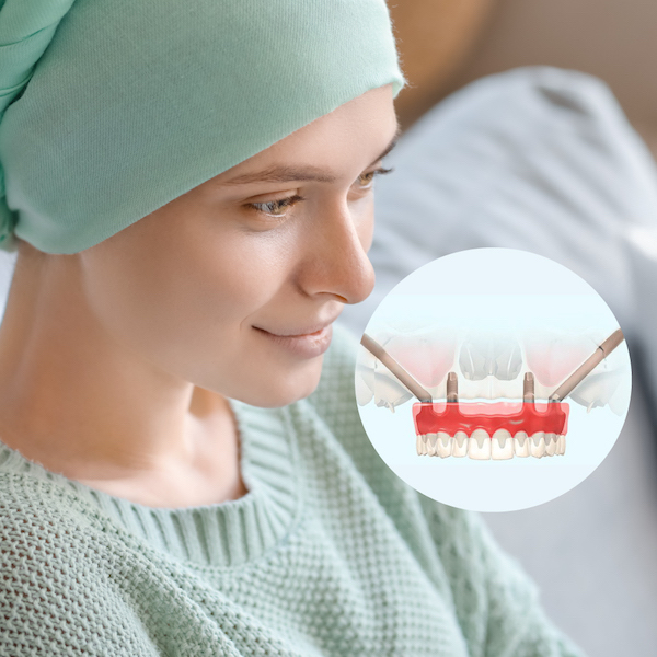 impianti dentali zigomatici per pazienti oncologici
